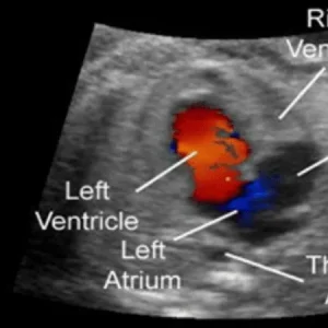 2D Echo color Doppler